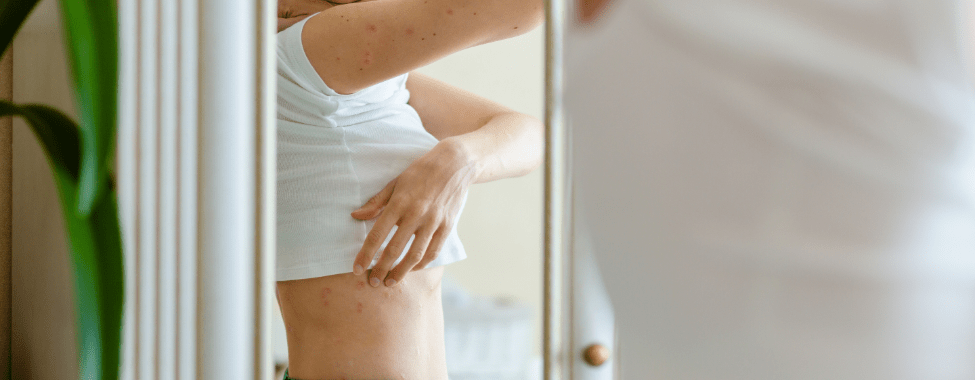 Woman Checking Psoriasis in Mirror